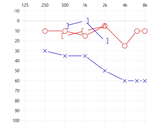audiogram-single-side-hearing-loss